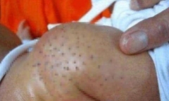 Gửi con trai ở nhà bà nội, người mẹ tá hỏa khi phát hiện cơ thể đứa trẻ chi chít vết chấm đen