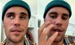 Justin Bieber bị liệt cơ mặt vì hội chứng hiếm gặp