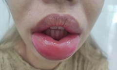 Môi sưng phồng như 