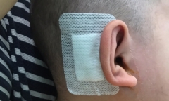 Cấy ốc tai điện tử cho bé trai 2,5 tuổi bị điếc bẩm sinh