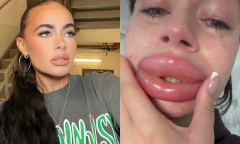 Đôi môi như mỏ vịt của cô gái tiêm filler miễn phí