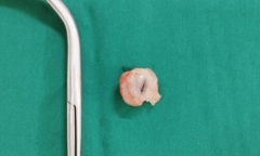 Bé 5 tuổi suy hô hấp nặng do hóc quả nhãn
