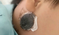 Bé 9 tuổi mắc viêm màng não do tự điều trị quai bị tại nhà, bác sĩ cảnh báo gì?