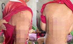 Bà hoảng hồn phát hiện trên người cháu đầy vết bầm tím, vội trình báo công an
