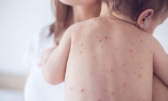 Hướng dẫn chăm sóc và những sai lầm cần tránh khi trẻ bị sốt xuất huyết