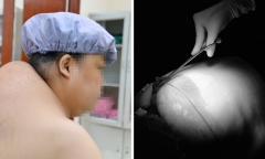 10 năm vác khối u 