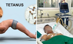 Tiếp nhận 2 ca mắc uốn ván do tự cắt trĩ tại nhà và ngã chuồng lợn