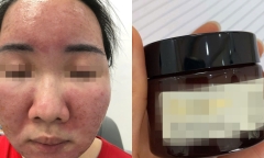 Dùng kem chống nắng xách tay không rõ nguồn gốc, giá bình dân, nữ sinh cháy da, bỏng mặt