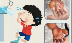 Bé gái 18 tháng tuổi bỏng nước sôi độ II-III, nhiễm trùng vì chữa sai cách