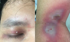 Ở chung cư cao tầng, người đàn ông hốt hoảng thấy mắt sưng, cổ rát vì loài vật ngỡ chỉ có dưới nhà mặt đất