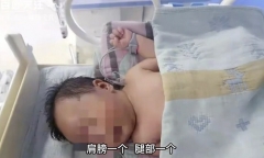 Bé trai bỗng có vết thương ở đùi, kết quả chụp CT hé lộ hành vi nhẫn tâm của bảo mẫu