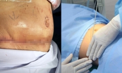 Bi hài hậu vận sau thẩm mỹ: Tin vào quảng cáo “hút mỡ không tái béo”, người phụ nữ 90kg nhận cái kết đắng ngắt
