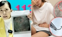 Đau đớn suốt 18 năm vì kim phẫu thuật “đi lạc” xuống chỗ hiểm
