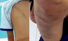 Cà Mau: Khởi tố mẹ kế đánh con chồng với hơn 20 vết bầm trên cơ thể