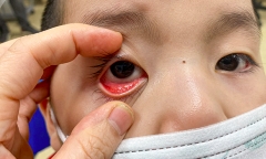 Viêm kết mạc hậu COVID ở trẻ em: Nguyên nhân và cách phòng tránh
