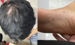 Đi khám vì rụng tóc, thanh niên ngỡ ngàng biết nguyên nhân từ cuộc tình một đêm