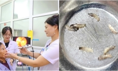 Rùng mình phát hiện ổ giòi 7 con làm tổ trong hốc mũi người phụ nữ ở Hà Tĩnh
