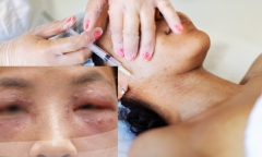 Tiêm meso giá rẻ tại spa, người phụ nữ 30 tuổi phải