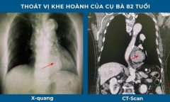 Tin tức đời sống ngày 20/5: Điều trị sai bệnh suốt 10 năm vì bị chẩn đoán nhầm