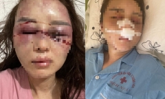 Vụ cán bộ QLTT đánh đập, lột đồ người tình: Kinh hoàng lời kể của nạn nhân