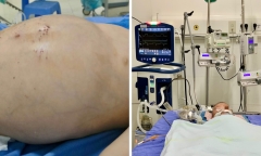 Bé 2 tuổi nguy kịch vì bố mẹ tự đắp lá chữa bệnh thận tại nhà