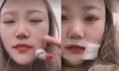 Người vợ bị chồng quăng móc câu trúng má khi đang đi câu cá với nhau