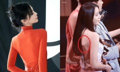 Chuyên gia thẩm mỹ cảnh báo trào lưu làm đẹp 'xương lưng cánh bướm' giống Angelababy, Địch Lệ Nhiệt Ba