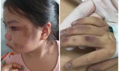 Bé gái bầm tím mặt vì bố