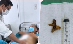 Tin tức đời sống mới nhất ngày 25/8: Hai người phải cắt thận chỉ vì một viên sỏi