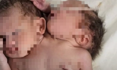 Hy hữu: Bé sơ sinh chào đời với 2 đầu và 3 tay