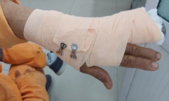 Đi nhắc nợ, nhân viên điện lực bị khách hàng đánh đứt gân ngón tay