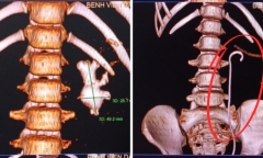 Sỏi thận tái phát, bệnh nhi 9 tuổi được phẫu thuật sau 3 lần mổ trước đó