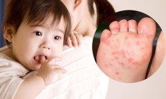 Bộ Y tế thông tin về thuốc điều trị bệnh chân tay miệng thể nặng