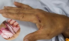 Đứt tay khi mổ lợn, người đàn ông nhiễm liên cầu lợn sau khi dùng tay bốc thịt