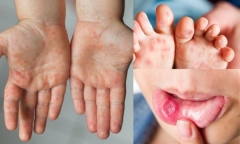 Tìm ra kiểu gen gây bệnh tay chân miệng nặng tại TP HCM