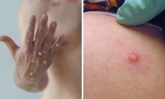 TP.HCM: Ghi nhận ca thứ 5 mắc đậu mùa khi ở quận Tân Bình