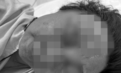 Tin tức đời sống 27/9: Nổi mụn nước tưởng dị ứng da, không ngờ nhiễm virus gây biến chứng nguy hiểm