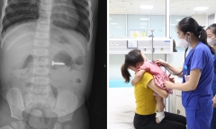 Bé 2 tuổi nuốt phải dị vật khi sang nhà hàng xóm chơi, bác sĩ cảnh báo nguy hiểm