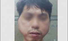 Thanh niên 29 tuổi tố bị chủ quán lẩu nướng ở Hà Nội đánh biến dạng khuôn mặt