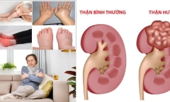 Xuất hiện những biểu hiện này, cẩn thận kẻo mắc 