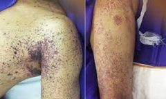 Bắc Giang: Người đàn ông hôn mê, nguy kịch sau 2 ngày mổ lợn