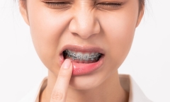 Mối nguy rình rập khi lỡ niềng răng sai cách và cách chăm sóc sau khi 
