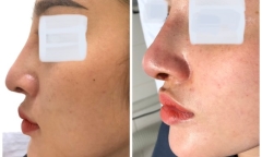 Cô gái bị nhiễm trùng, lộ sống mũi sau khi nâng mũi 6 tháng