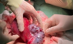 Cần Thơ: Kịp thời cứu sống  bé gái 15 tuổi bị u buồng trứng biến chứng