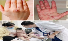 Dịch tay chân miệng diễn biến phức tạp, bác sĩ mách phụ huynh các biện pháp phòng bệnh trước thềm năm học mới