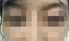 Cắt mí ở thẩm mỹ viện 