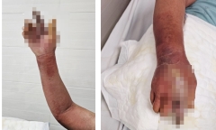 Tai nạn trong nhà khiến người đàn ông phải nhập viện cấp cứu