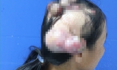 Người phụ nữ có nhiều khối u kỳ lạ trên đầu, nguyên nhân do mắc bệnh không phổ biến ở Việt Nam