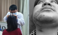 Bi hài hậu vận sau thẩm mỹ: Tiêm filler xóa nhăn tạo