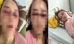 Vụ cán bộ QLTT bị tố đánh đập, lột đồ người tình: Vì sao chưa thể giám định thương tật nạn nhân?